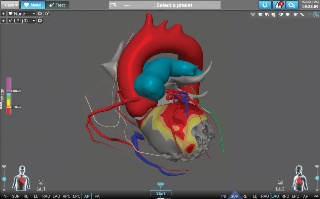 Le CHU de Toulouse déploie un jumeau numérique du cœur pour les interventions cardiaques
