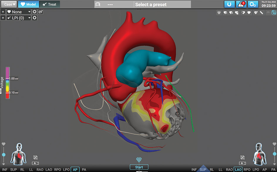 Twin+ jumeau numerique sante coeur InHeart CHU TouIouse Affera